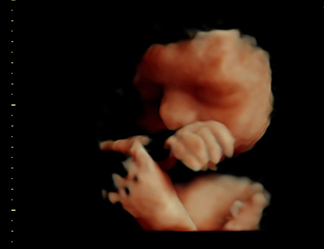 3D ultrasound image at 31 weeks